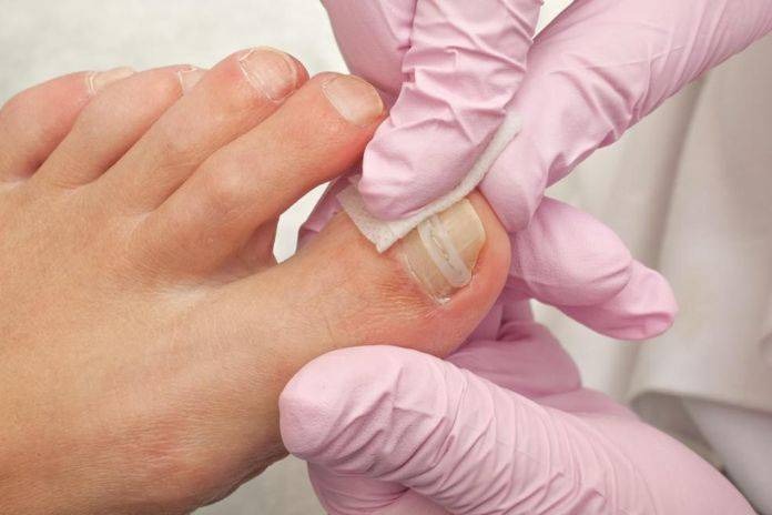 How To Treat An Ingrown Toe Nail