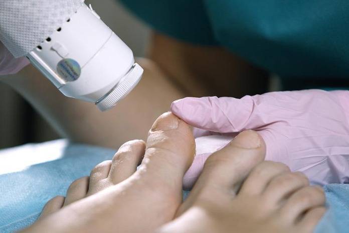 Learn Everything About Laser Treatment For Nail Fungus