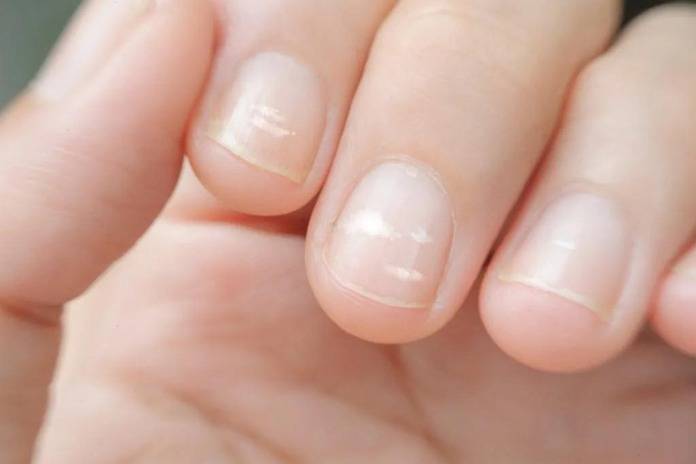 White Spots On Your Fingernails