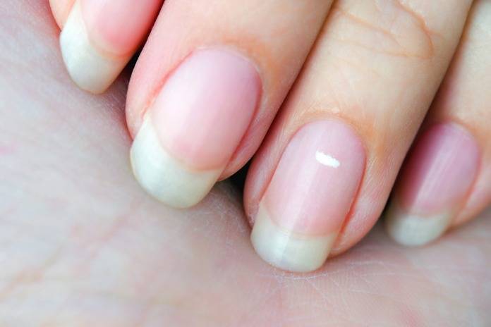 white lines on nails